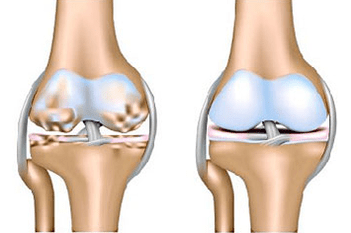 Healthy wrist and arthrosis