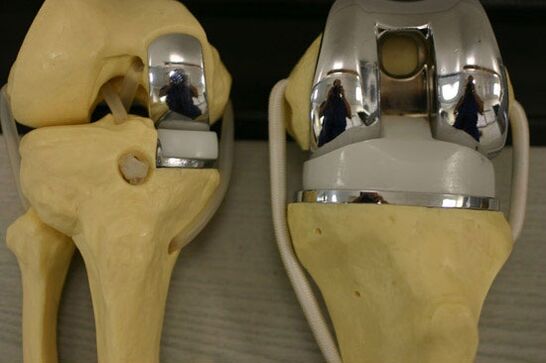 Variants of the endoprosthetics of the knee joint