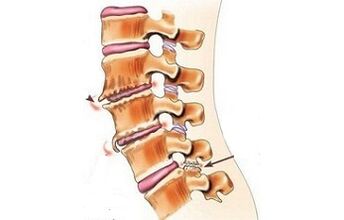 spondylthreading as causes of back pain