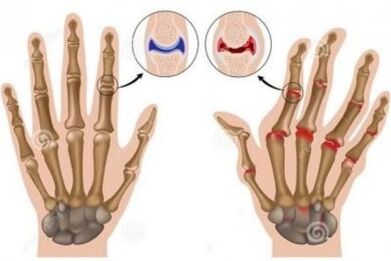 Causes of pain in the joints of the fingers