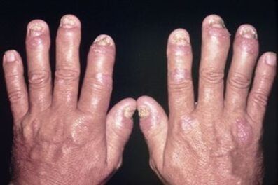 Why hurts the joints of your fingers