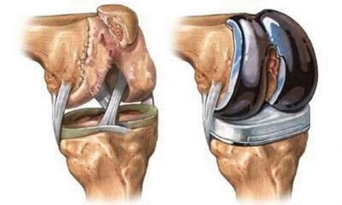 EndoProsthetics of coupling knee for arthrosis