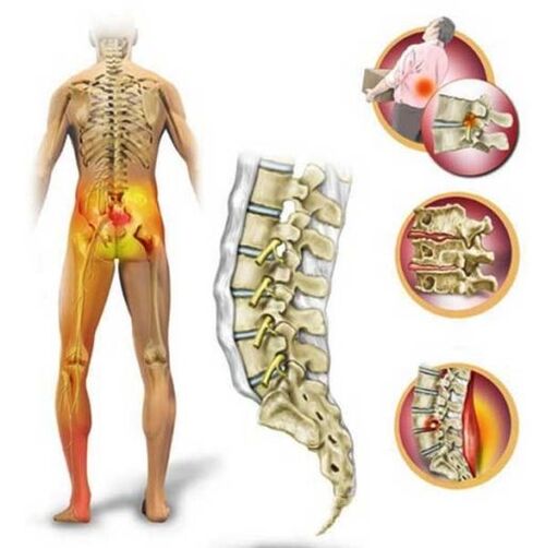 Osteochondrosis of the lumbar spine, which causes pain in the lower back
