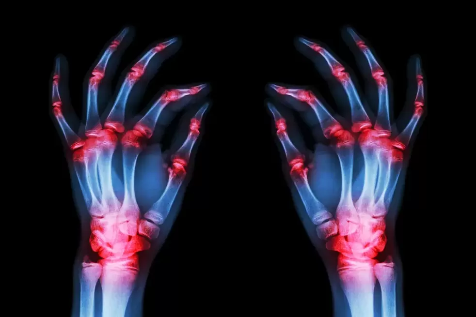 arthrosis of finger joints