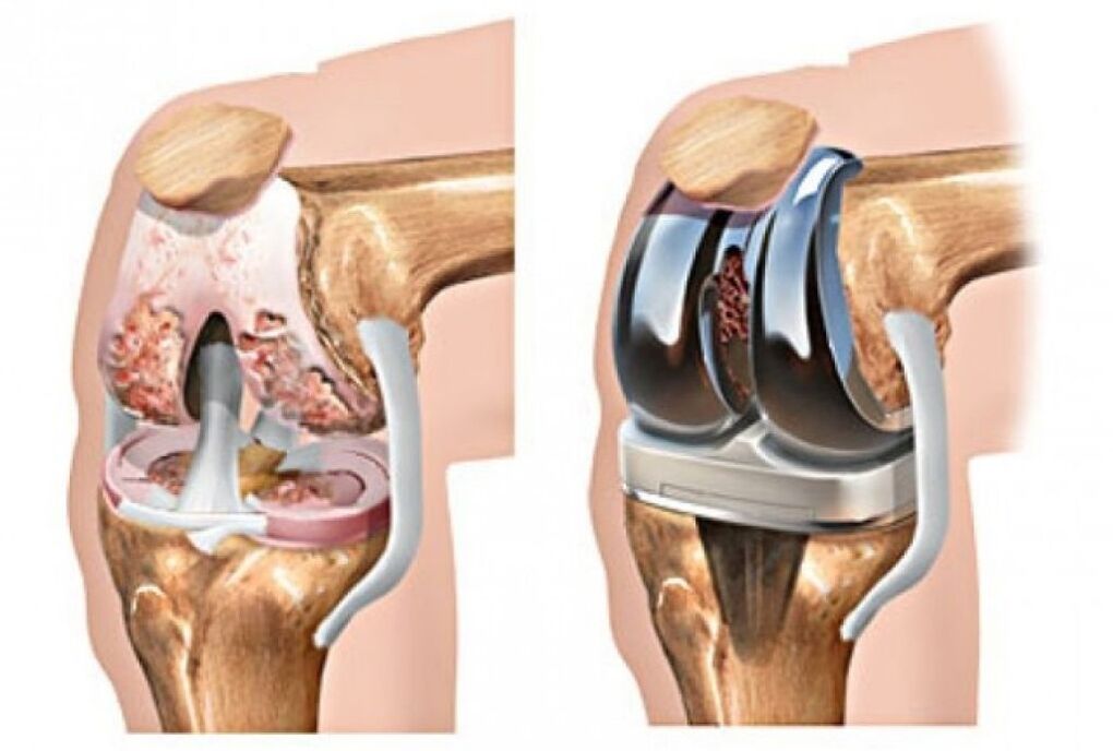 knee arthroplasty for osteoarthritis