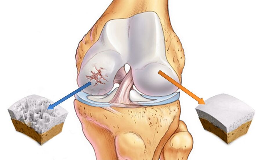 Healthy knee joint (right) and affected by arthrosis (left)