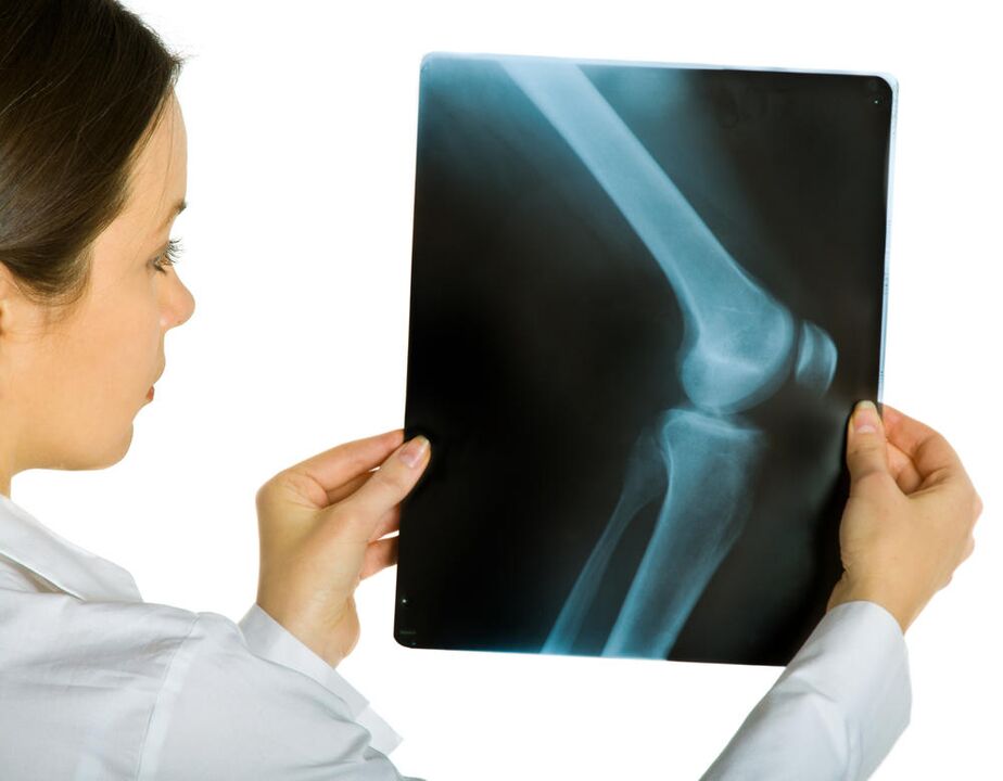 X-ray of the knee joint will reveal the presence of deforming arthrosis
