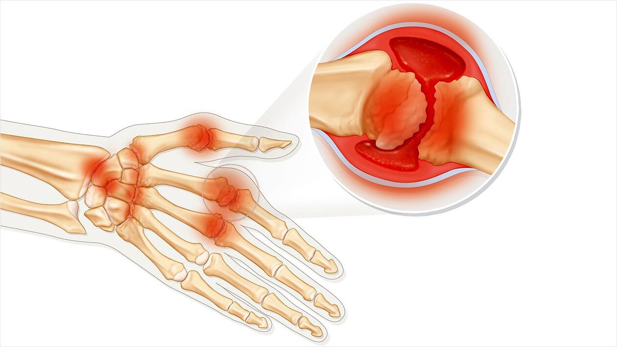osteoarthritis treated with Traugel